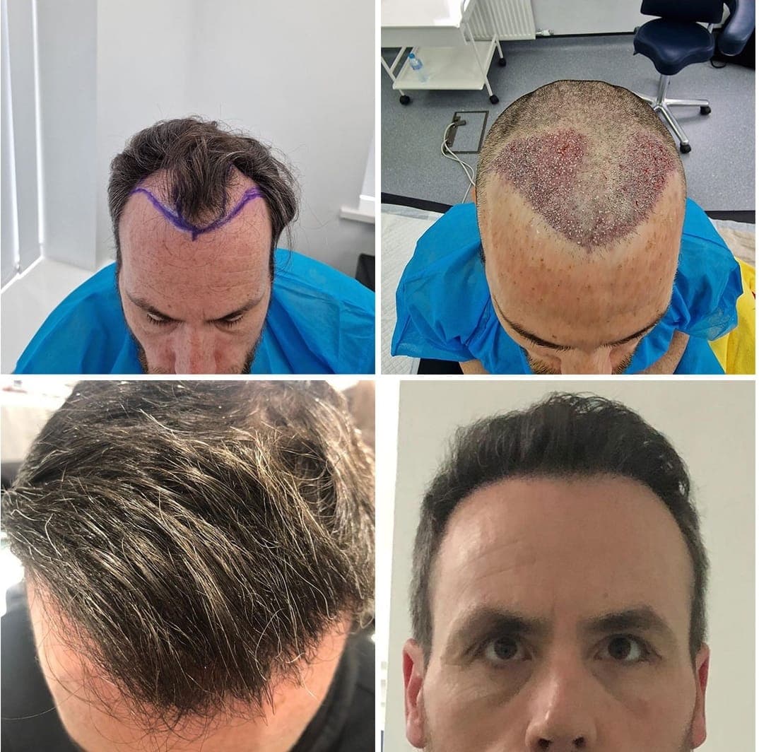 Hair Transplant UK Costs – Understanding Pricing and Value